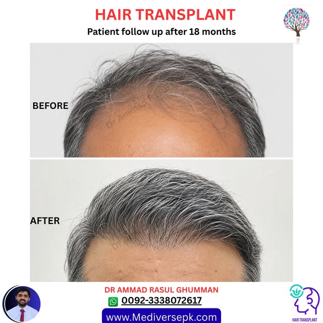 👨‍⚕️ Hair Transplant in Gujranwala, Pakistan ✨

Tired of hair loss, a receding hairline, or thinnin