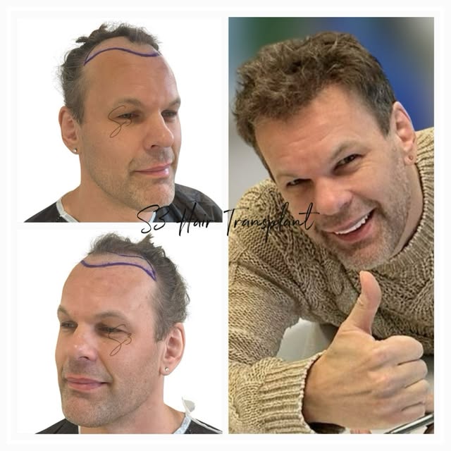 From thinning to thriving 🚀 This incredible transformation at S3 has taken years off his appearance