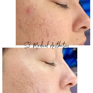 From congested and dull skin to clear and radiant skin with just ONE session of HydraFacial MD+ Micr