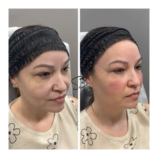 Cheeks are so underrated! This stunning before-and-after was achieved using two contour syringes wit