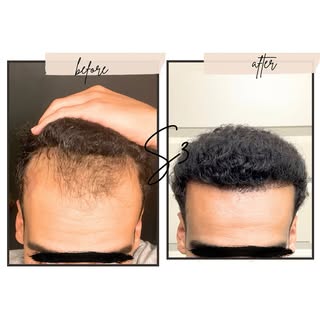 Wow! Our patient’s 12 months post FUE transformation speaks for itself. Thicker, denser, natural gro