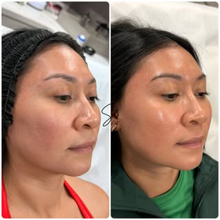 Before & after following one micro-needling + PRP on this beauty! Note the smoother & glowing skin, 