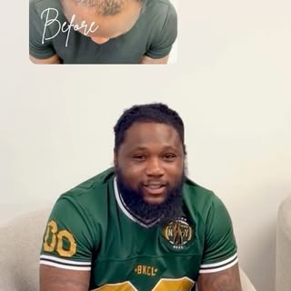 8 months. Not final. Already transformative 💫
Hair transplant results in a patient with highly text