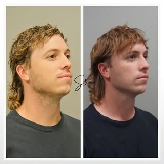 ᴊᴀᴡʟɪɴᴇ & ᴄʜɪɴ ᴇɴʜᴀɴᴄᴇᴍᴇɴᴛ

Before & 5 days post-op

This patient wanted a stronger, more structured