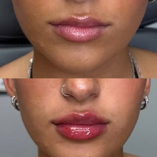 Perfect lips always @allaboutaestheticsfl 💕💕
•
•
•
•
•
•
•
•
•
#lips #plumplips #prettylips #boca 