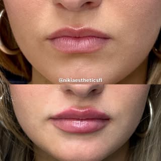 Amazing correction on both upper and lower lip 🙌🏻👄 

📱561-757-7391
📍Boca Raton, FL 33433

#nurs