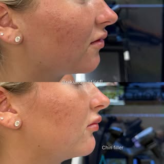 This anterior projection needed some balancing 🤍

📱561-757-7391
📍Boca Raton, FL

#chinfiller #mas