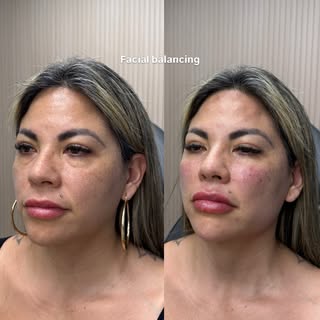 Lunchtime facial balancing - cheeks, chin, lips, jawline plus botox! 

📱561-757-7391
📍Boca Raton, 