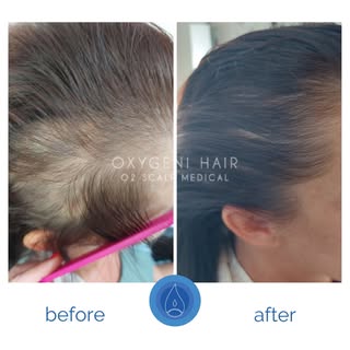 ✨ 10 alkalom Oxygeni Hair oxigénterápia eredménye ✨

A haj és a fejbőr regenerációja időt és követke