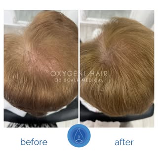 💚 5 alkalom Oxygeni Hair oxigénterápia eredménye ✨

A képeken jól látható, milyen változás érhető e