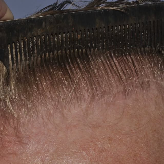50 years old. 8 years post-transplant. 2,400 grafts. ✨

A look at this long-term hair transplant res