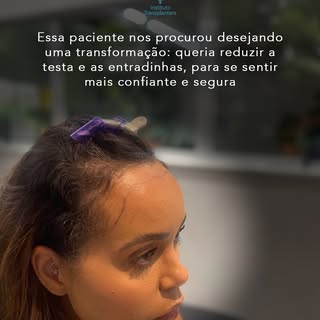 Confira essa história de sucesso de um transplante capilar feminino sem raspar os cabelos e surpreen