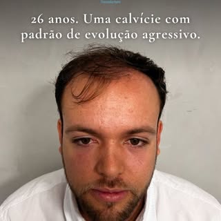 Paciente jovem com calvície significa alta tendência a perder os cabelos. Cirurgia pode ser uma ótim