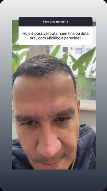 Finasterida e dutasterida são extremamente importantes em alguns casos. Em outros nem tanto. Confira