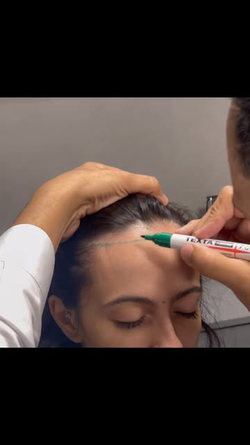 Um dia de arte e alegria: #transplantecapilarfeminino. Sem raspar nenhum fio. Assista até o final e 