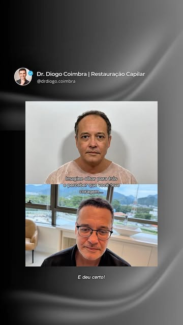 Muitos pacientes convivem com a calvície por anos antes de decidir começar um tratamento. Esperam o 
