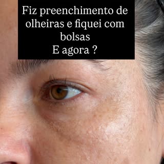 E quando o preenchimento de olheiras dá errado… e a paciente é alérgica à hialuronidase? 😳

Essa é 