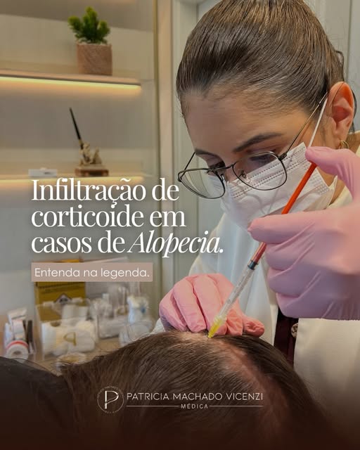 A infiltração de corticoide é uma opção de tratamento para adultos com Alopecia Areata: aquela queda