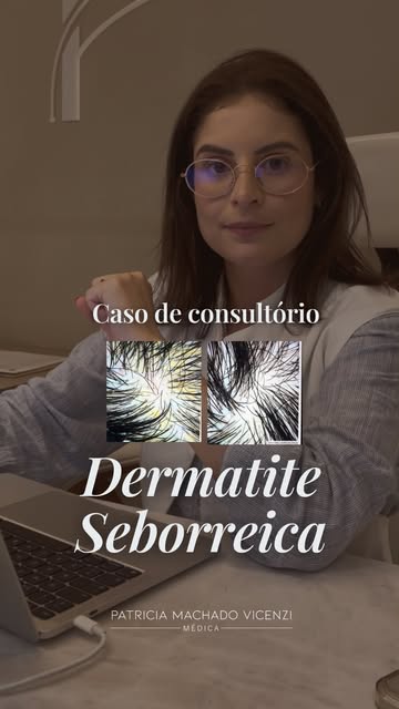 Quando a dermatite seborreica não é tratada, ela pode ir muito além da caspa.

Esse foi o caso que a