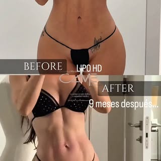 Confía en el proceso… 
BEFORE: 20 días post lipo 
AFTER: 9 meses post 
Tu LIPOSUCCIÓN cada día se ve
