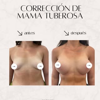 Antes y después · Corrección de mama tuberosa

La mama tuberosa requiere un abordaje específico que 