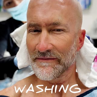 "how to care for implanted hair" 😂 Something I've wanted to do for 20 years! A good Dr + time, pati