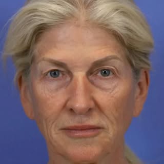 “Hey Dr Bitner, I want to look younger and I’ve always hated my nose. Can we fix both?” - Heck yeah!