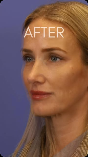 Four months out from her #rhinoplasty and looking amazing! She came from out of the country and I ha