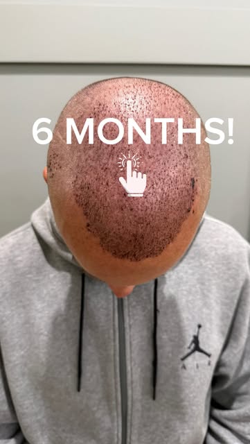 6 MONTH TRANSPLANT UPDATE!

Still growing. Still filling in. No hat required. Talk about "MiracleGro