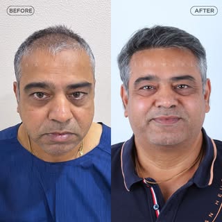 From Oman to Indore International Trust, Indian Expertise – Hair Transplant by Dr. Ankit Khasgiwala 