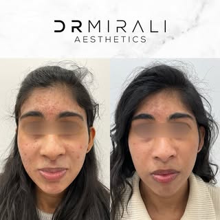 *ACNE SKINCARE TRANSFORMATION*

This lovely client came to me with concerns being challenged by 10 y