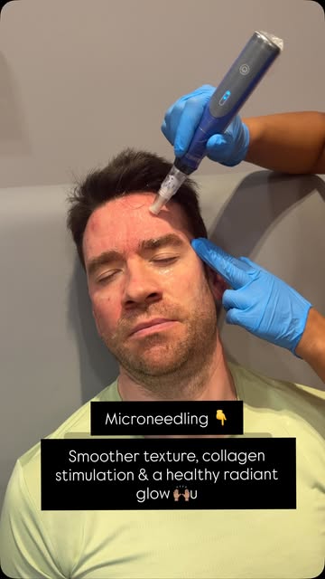*Microneedling-COLLAGEN stimulation* 

From about 25, we begin to lose 1% collagen in the skin a yea