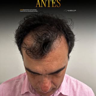 O poder do antes e depois: transformação que você vê e sente! ✨

O antes e depois de um transplante 