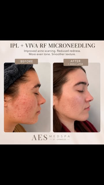 ✨ ACNE SCARS • REDNESS • POST-INFLAMMATORY PIGMENTATION ✨

When acne leaves behind more than just a 