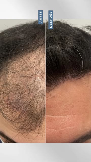 💙 Un antes y un después que se nota, pero que busca seguir pareciendo tuyo.

En un injerto capilar,