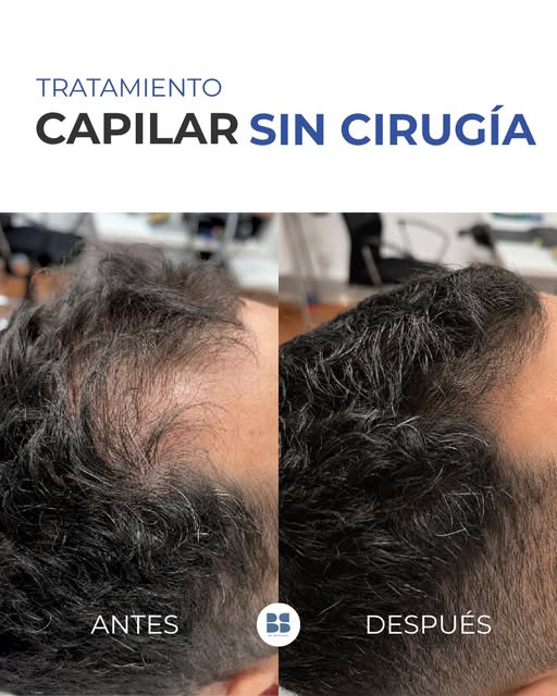 💙 ¿Sabías que no siempre es necesario recurrir a un injerto capilar para mejorar la densidad?

Cuan