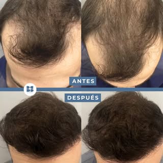 🧐 ¿3.000 unidades foliculares significa 3.000 pelos? No.

Este es uno de los conceptos que más conf
