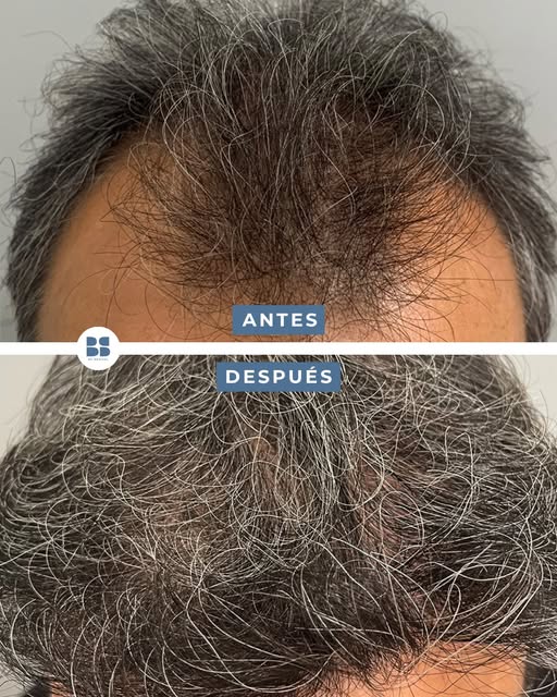 🧬 ¿Por qué el pelo trasplantado mantiene sus características?

En un injerto capilar se utilizan fo