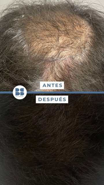 🔬 Un folículo no es igual a un pelo. ¿Lo sabías?

En un injerto se extraen unidades foliculares, y 