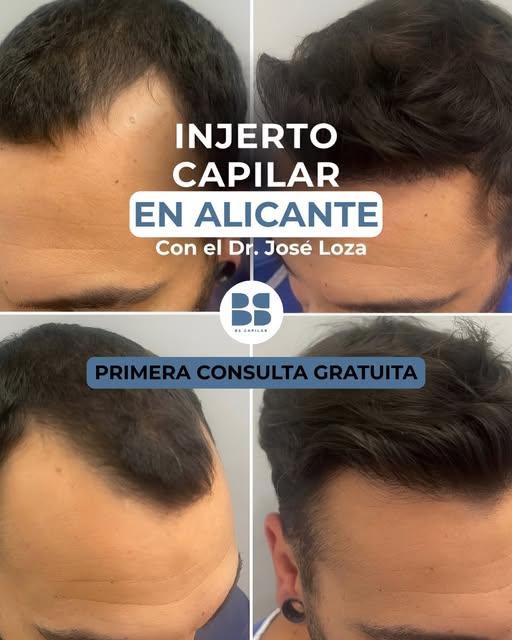 💙 Un resultado que no necesita demasiadas explicaciones.

En este caso, el injerto capilar ha permi