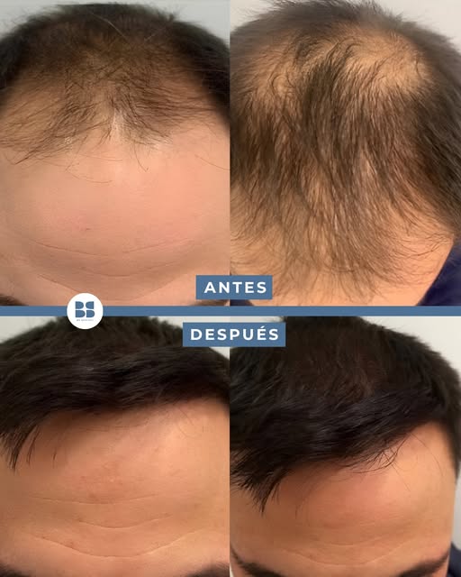 🧑🏻‍⚕️ ¿De qué depende que un trasplante capilar se vea natural?

No solo de la cantidad de folícul
