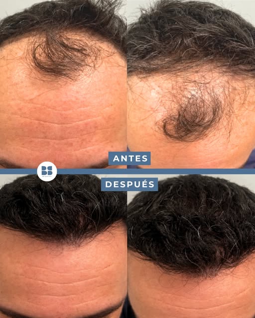 💙 Cuando el cambio está en recuperar lo que se había ido perdiendo.

En este caso vemos una mejora 