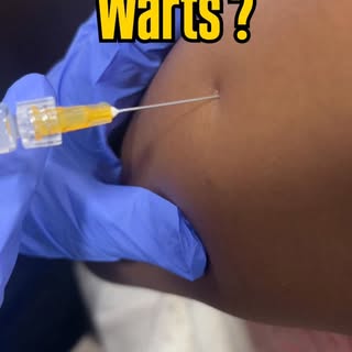 Genital warts treatment easily done by vaccination (gardasil 9)
HPV vaccine not only protects agains