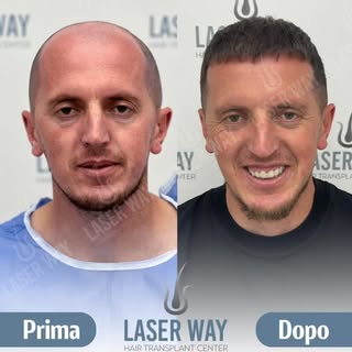 20 Anni di Esperienza nel Trapianto di Capelli!

Dopo due decenni, la Laser Way Clinic è diventata s