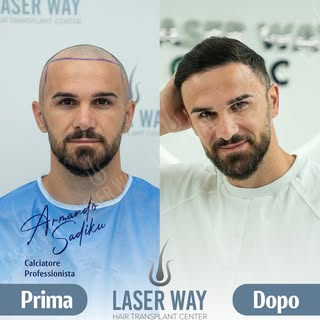 20 Anni di Esperienza nel Trapianto di Capelli!

Dopo due decenni, la Laser Way Clinic è diventata s