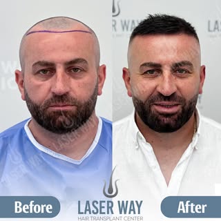 20 Anni di Esperienza nel Trapianto di Capelli!

Dopo due decenni, la Laser Way Clinic è diventata s