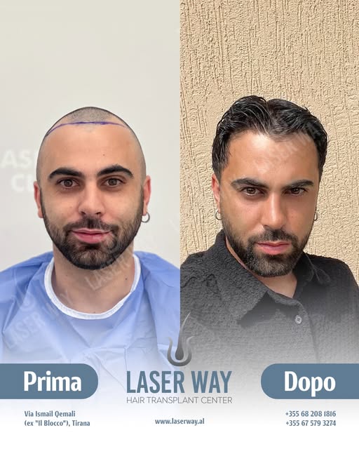 20 Anni di Esperienza nel Trapianto di Capelli!

Dopo due decenni, la Laser Way Clinic è diventata s