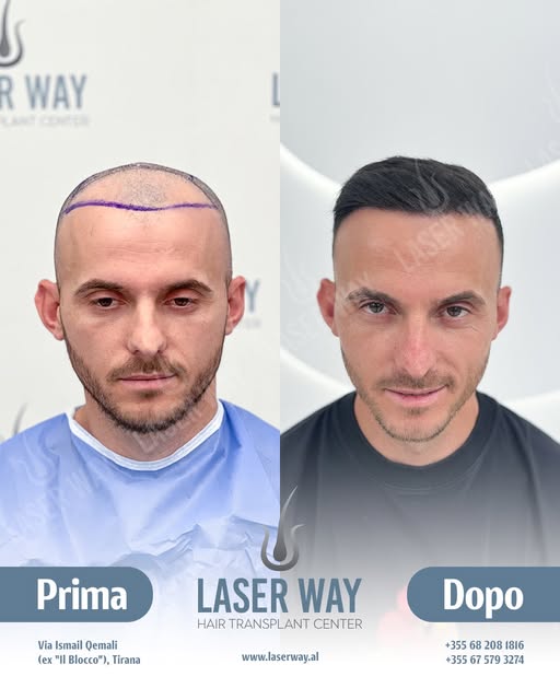 20 Anni di Esperienza nel Trapianto di Capelli!

Dopo due decenni, la Laser Way Clinic è diventata s