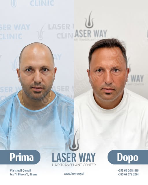 20 Anni di Esperienza nel Trapianto di Capelli!

Dopo due decenni, la Laser Way Clinic è diventata s