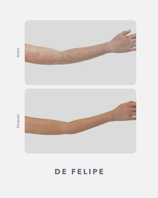 🌿Antes y después de manchas solares. Te explicamos el caso completo: diagnóstico, tratamiento y cui